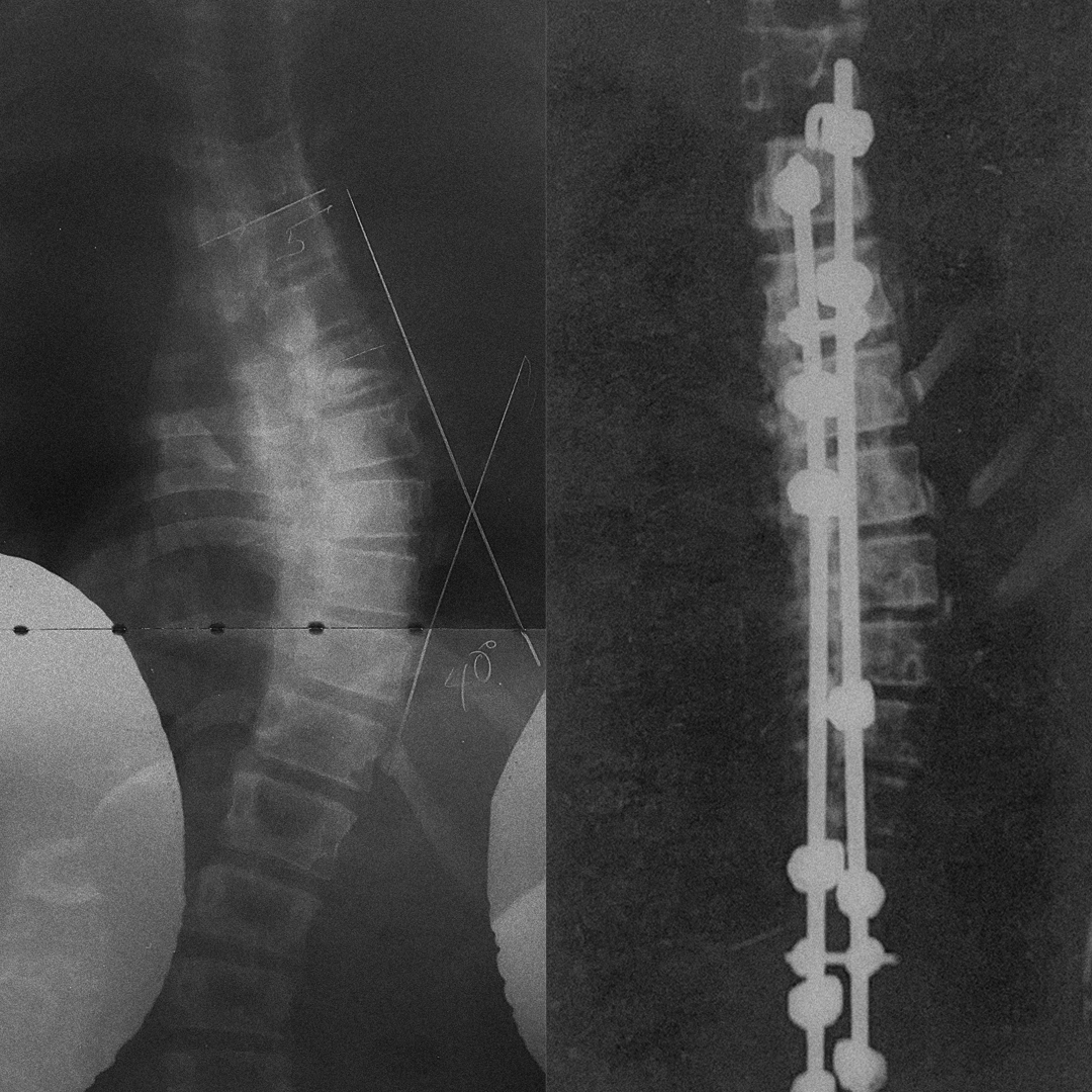EmmaSiewert's tweet photo. 💚twenty years ago💚 #scoliosis https://t.co/J6O7XJ2ryf