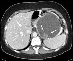 Gio_Marchegiani's tweet photo. Should ALL mucinous cystic neoplasms 🥑 of the pancreas be resected?! 🤔

Guidelines 🤜🤛 Meta Analysis 4k pts

😱 Malignancy 16% 
🦀 Size 65 mm and mural nodules are predictors 

👀 Surveillance has definelty a role in MCN, at least at 1st observation 

https://t.co/3NR3waBheY https://t.co/ASeGyhMh1J