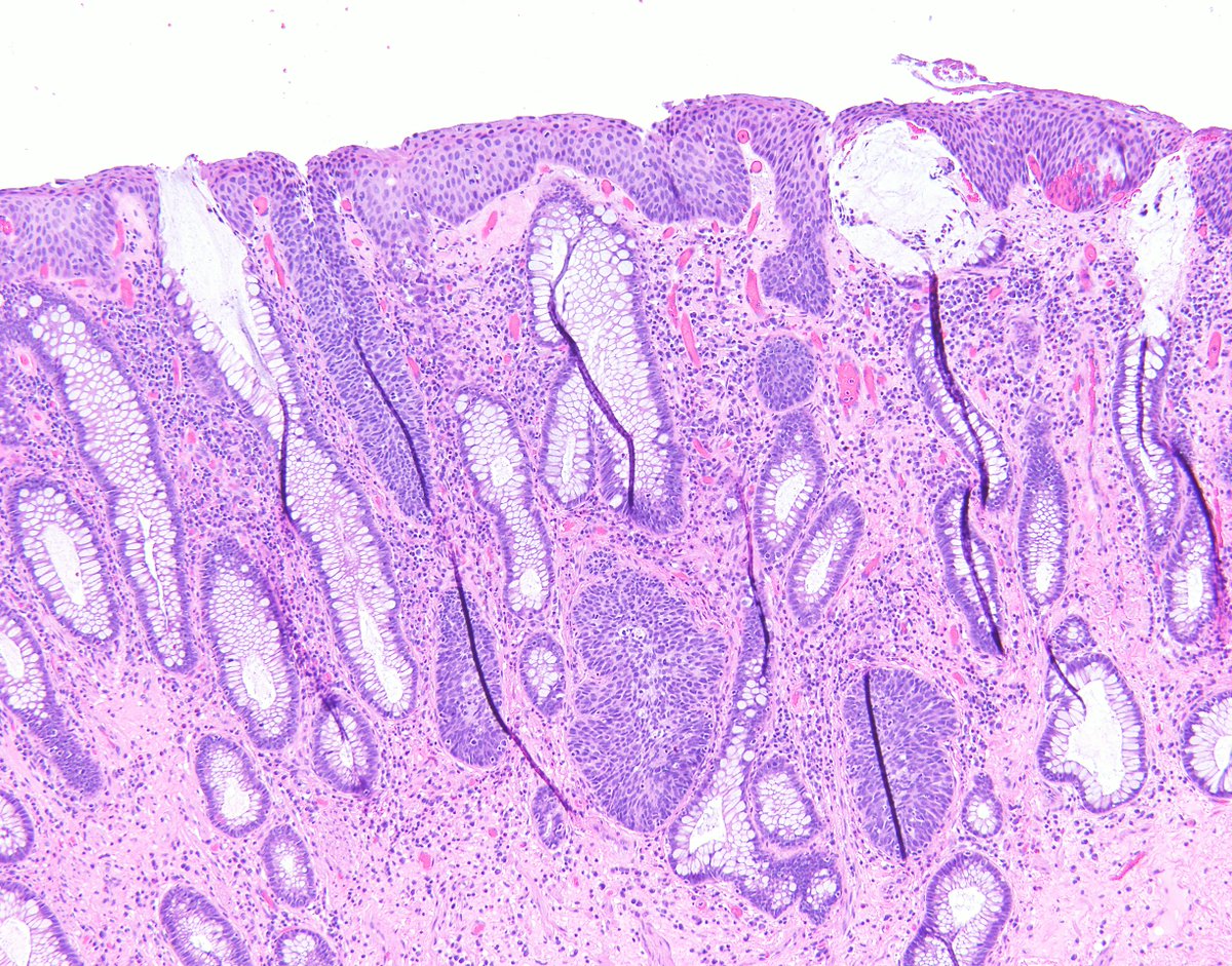 When you think you can quickly sign out a benign case that comes with a rectal prolapse resection...😮.  
#HPV #vaccinepreventable #pathology #MedEd @nyugrossman @NYUGSOMpathres