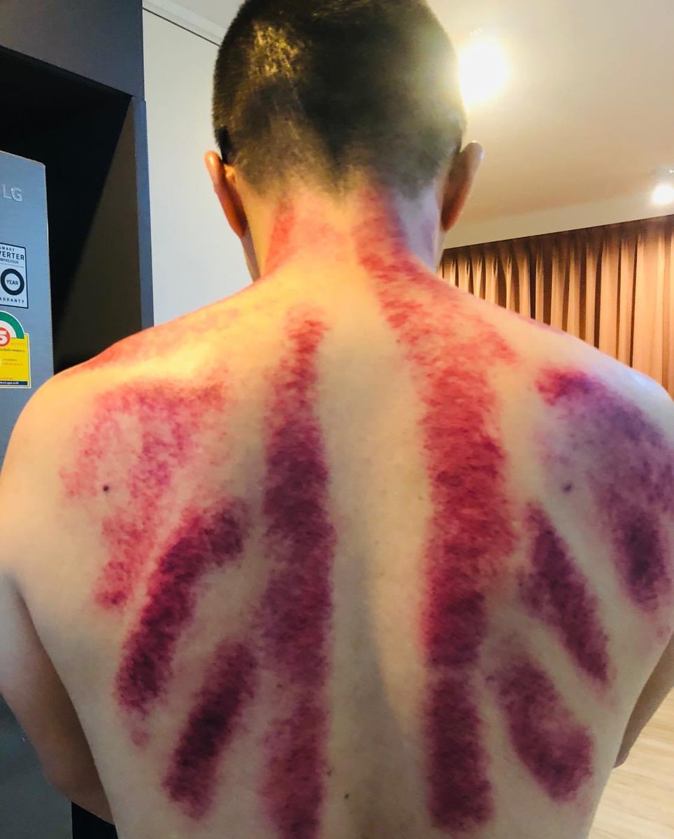 我不是……
刮痧、拔罐、推拿按摩的師傅😈 
#看心情服務
這個小鮮肉應該壓力太大了吧！
打完 刮痧馬上紅成這樣！
姐姐會好好照顧你的 放心！ https://t.co/DdAFRmACv6