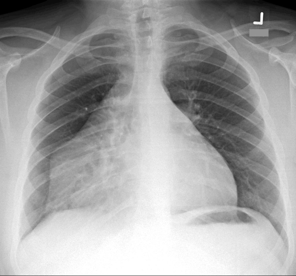 MoreXGrok's tweet photo. 22-year-old male, no significant past medical history, presents with acute chest pain after strenuous exercise.

Please describe the abnormal findings.

What is your diagnosis? https://t.co/imi7oH7EJB