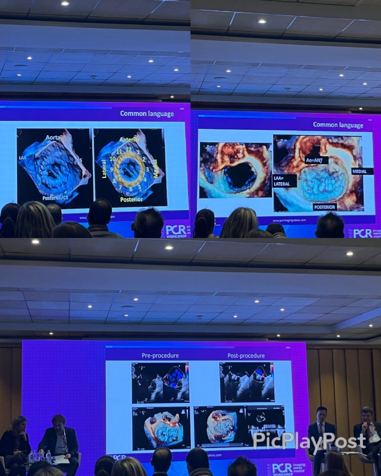 #PCRimaging valves Madrid stressing the role of a common language between interventionalists and imagers. How important is this to you for procedural success? Vote below. #echofirst #CardioTwitter