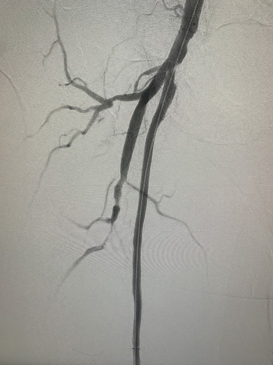 banderaldhafery's tweet image. #CLI with Flush #SFA chronic total occlusion , occluded ATA and PTA , distal SFA  puncture and #revascularization #amputation prevention 

#endovascular #IR #interventional #MedTwitter #CTO