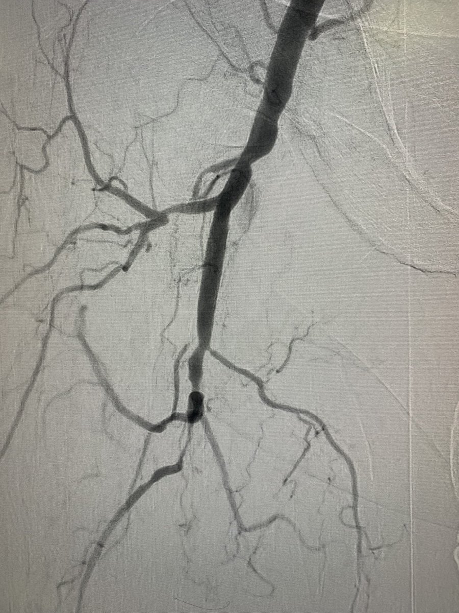 banderaldhafery's tweet image. #CLI with Flush #SFA chronic total occlusion , occluded ATA and PTA , distal SFA  puncture and #revascularization #amputation prevention 

#endovascular #IR #interventional #MedTwitter #CTO
