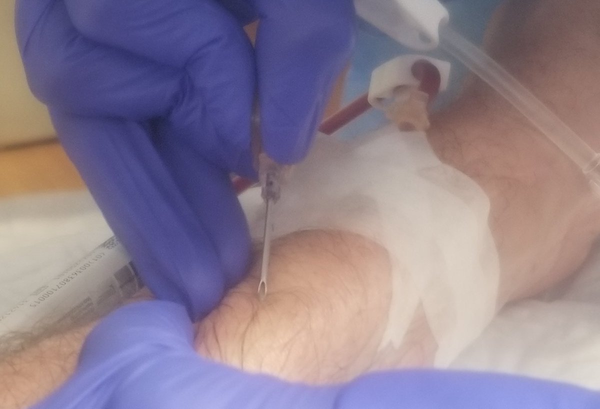 Tom Weiser ๐บ๐ธ๐๐ฆ (@weisertom) on Twitter photo #LDLapheresis treatment number 218 at the <a href="/ReadingHosp/">Reading Hospital - Tower Health</a> #HoFH #RareDisease Do you #KnowFH because #FHCantWait #LDLapheresis treatment number 218 at the <a href="/ReadingHosp/">Reading Hospital - Tower Health</a> #HoFH #RareDisease Do you #KnowFH because #FHCantWait