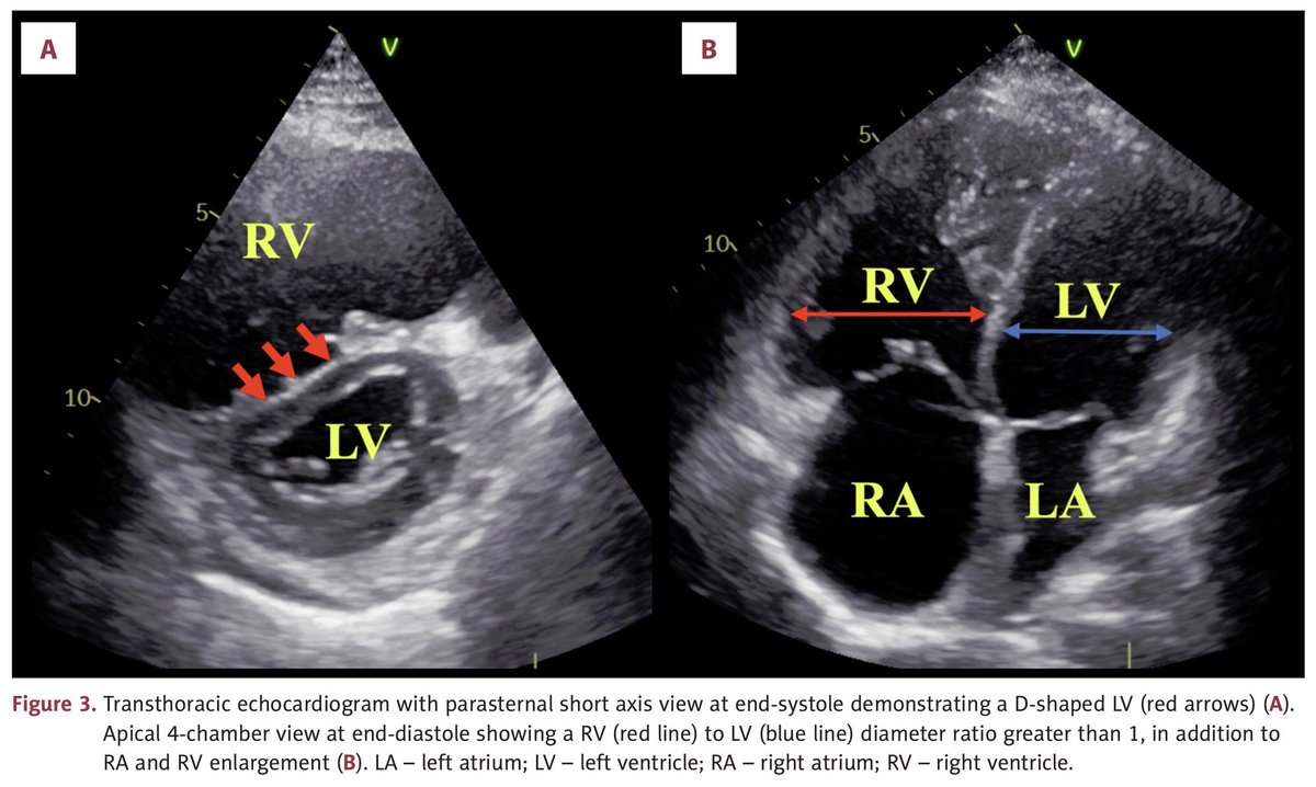 Juanma_Munoz29's tweet photo. I am happy to announce that our article on High-Risk #PulmonaryEmbolism secondary to the association of #PrimaryAPS and #Hyperhomocysteinemia has been published in the American Journal of Case Reports👨🏻⚕️🫀🇵🇪 @anth_ramosMD @EsalcedoMD @alcaldecarlos94 @CarinaHalanoca Dr. Requena🤝 https://t.co/V7i4a2saFo