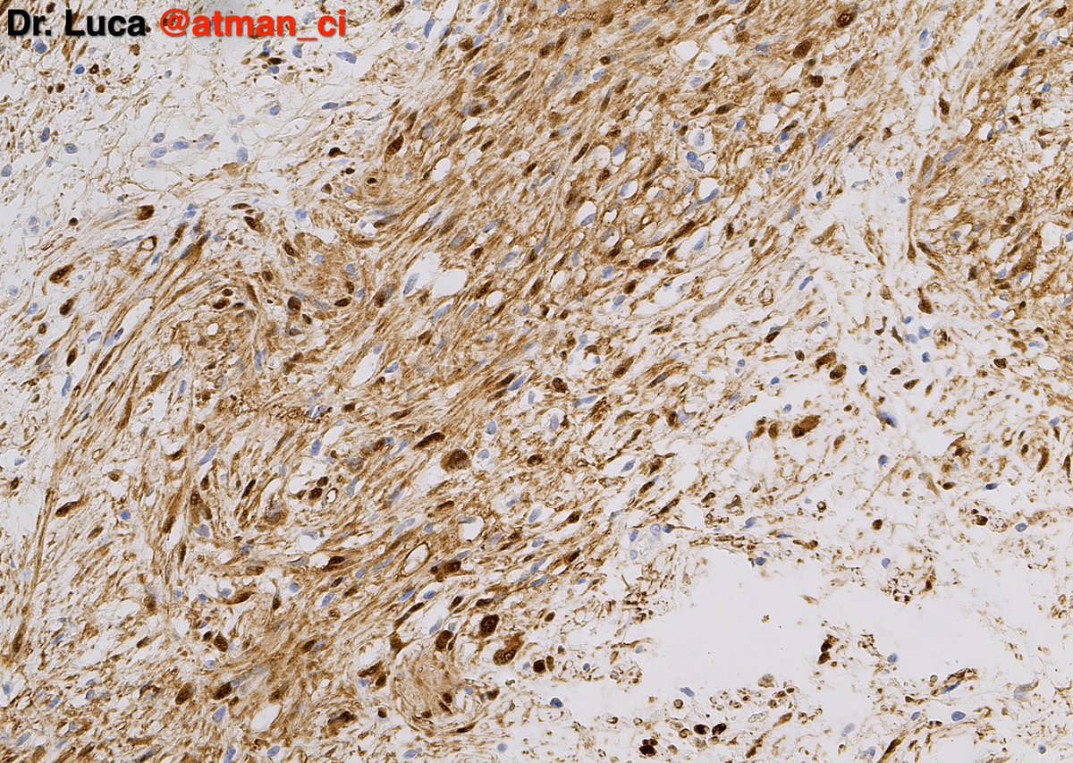 Three different #BSTPath entities and the same IHC marker, are you able to tell me which diagnoses and which shared IHC? <a href="/PoloniaAntonio/">A. Polónia</a> <a href="/DrBMcGinn/">Barry McGinn</a> <a href="/NeoCrazee/">SANO Naoki, MD, Pathologist, Japan</a> <a href="/sumeyra_md/">Sumeyra Kartal</a> @caseypschukow <a href="/LepinePathol/">Charles Lépine, MD</a> <a href="/rehdam/">Rehdam (Madiha)</a> <a href="/ZKrikic/">zigic krikic</a> <a href="/nusrat_xahra/">🔻Nusrat Zahra🔻🇵🇸</a> <a href="/Kashifhazim/">Kashif M M, MD, FRCPath</a> <a href="/goziemnweke/">idlewild</a> #PathTwitter 
Case N°1: