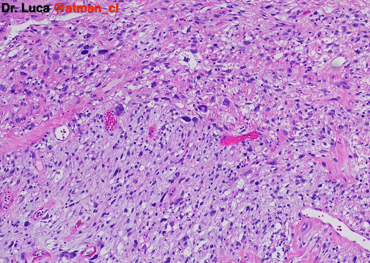 atman_ci's tweet photo. Let's go to case N°2, here the IHC to guess is expressed only focally @PoloniaAntonio @DrBMcGinn @NeoCrazee @sumeyra_md @caseypschukow @LepinePathol @rehdam @ZKrikic @nusrat_xahra @Kashifhazim @goziemnweke @Venkateshgilly2 @DrBonita16 #pathology #PathTwitter #BSTPath https://t.co/FWtcBVJdPj