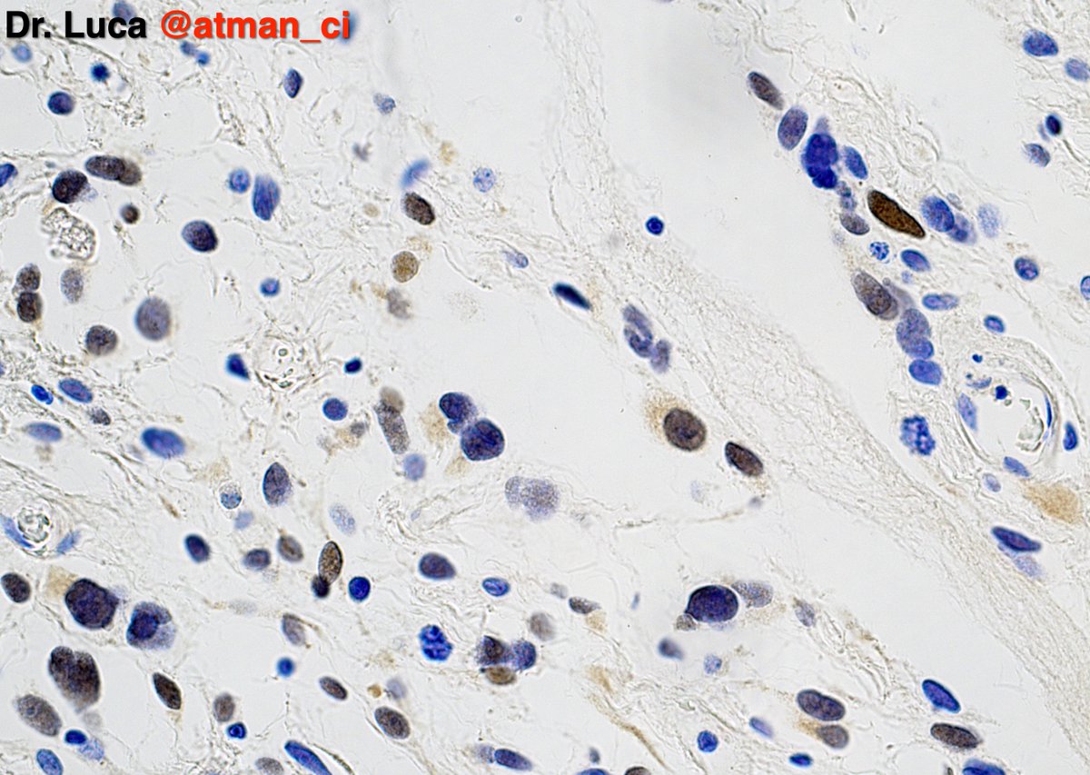 Let's go to case N°2, here the IHC to guess is expressed only focally <a href="/PoloniaAntonio/">A. Polónia</a> <a href="/DrBMcGinn/">Barry McGinn</a> <a href="/NeoCrazee/">SANO Naoki, MD, Pathologist, Japan</a> <a href="/sumeyra_md/">Sumeyra Kartal</a> @caseypschukow <a href="/LepinePathol/">Charles Lépine, MD</a> <a href="/rehdam/">Rehdam (Madiha)</a> <a href="/ZKrikic/">zigic krikic</a> <a href="/nusrat_xahra/">🔻Nusrat Zahra🔻🇵🇸</a> <a href="/Kashifhazim/">Kashif M M, MD, FRCPath</a> <a href="/goziemnweke/">idlewild</a> <a href="/Venkateshgilly2/">Venkatesh Dhanasekaran</a> <a href="/DrBonita16/">Bonita Borah🌼</a> #pathology #PathTwitter #BSTPath