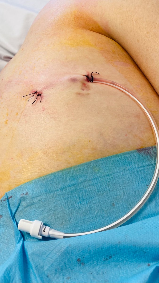 NeumologiaAvila's tweet photo. 🫁Catéter pleural tunelizado‼️
La principal indicación es el drenaje intermitente a largo plazo y de forma ambulatoria de los derrames pleurales malignos sintomáticos y recurrentes. 🧵 https://t.co/pYIxmyplt5