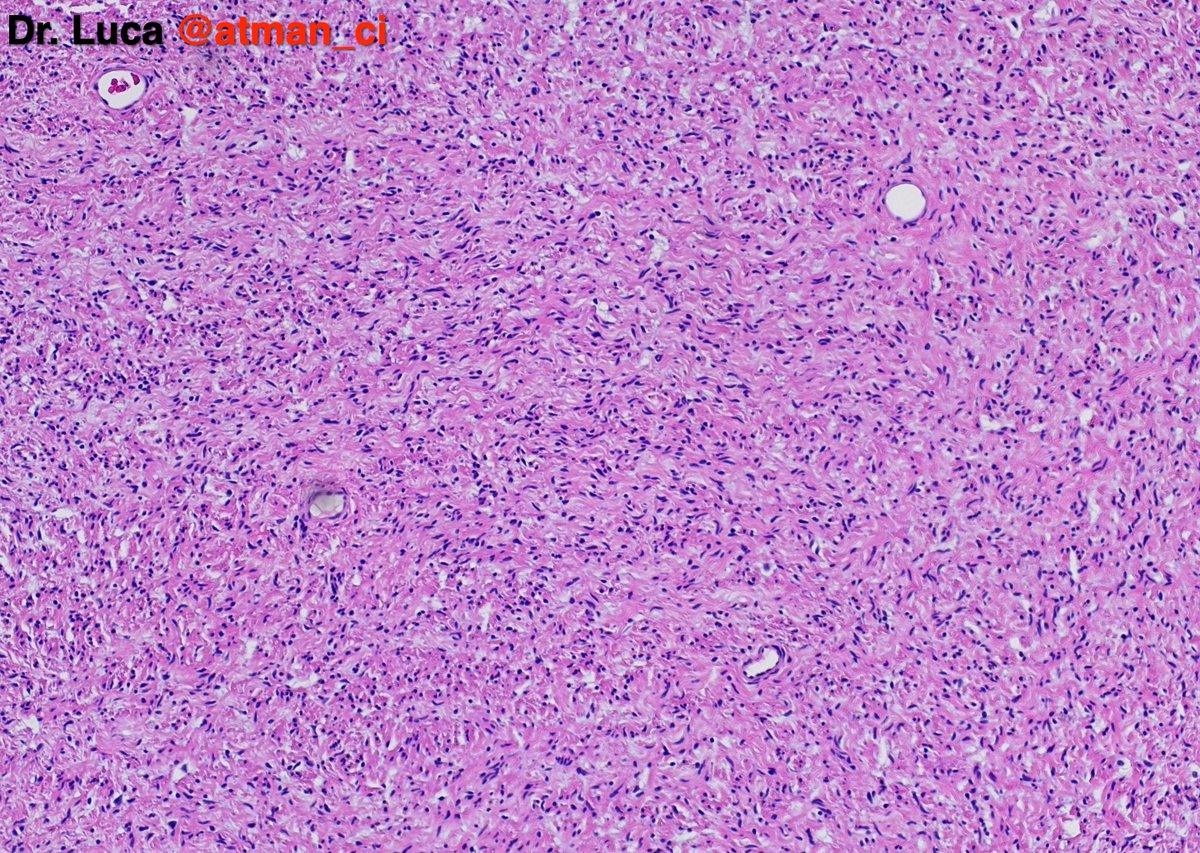 atman_ci's tweet photo. And finally Case N°3, a classic in #BSTPath #DermPath with this I wish you a great WeekEnd! @PoloniaAntonio @DrBMcGinn @NeoCrazee @sumeyra_md @caseypschukow @LepinePathol @rehdam @ZKrikic @nusrat_xahra @Kashifhazim @goziemnweke @Venkateshgilly2 #pathology #PathTwitter https://t.co/8X7Dep40Ao