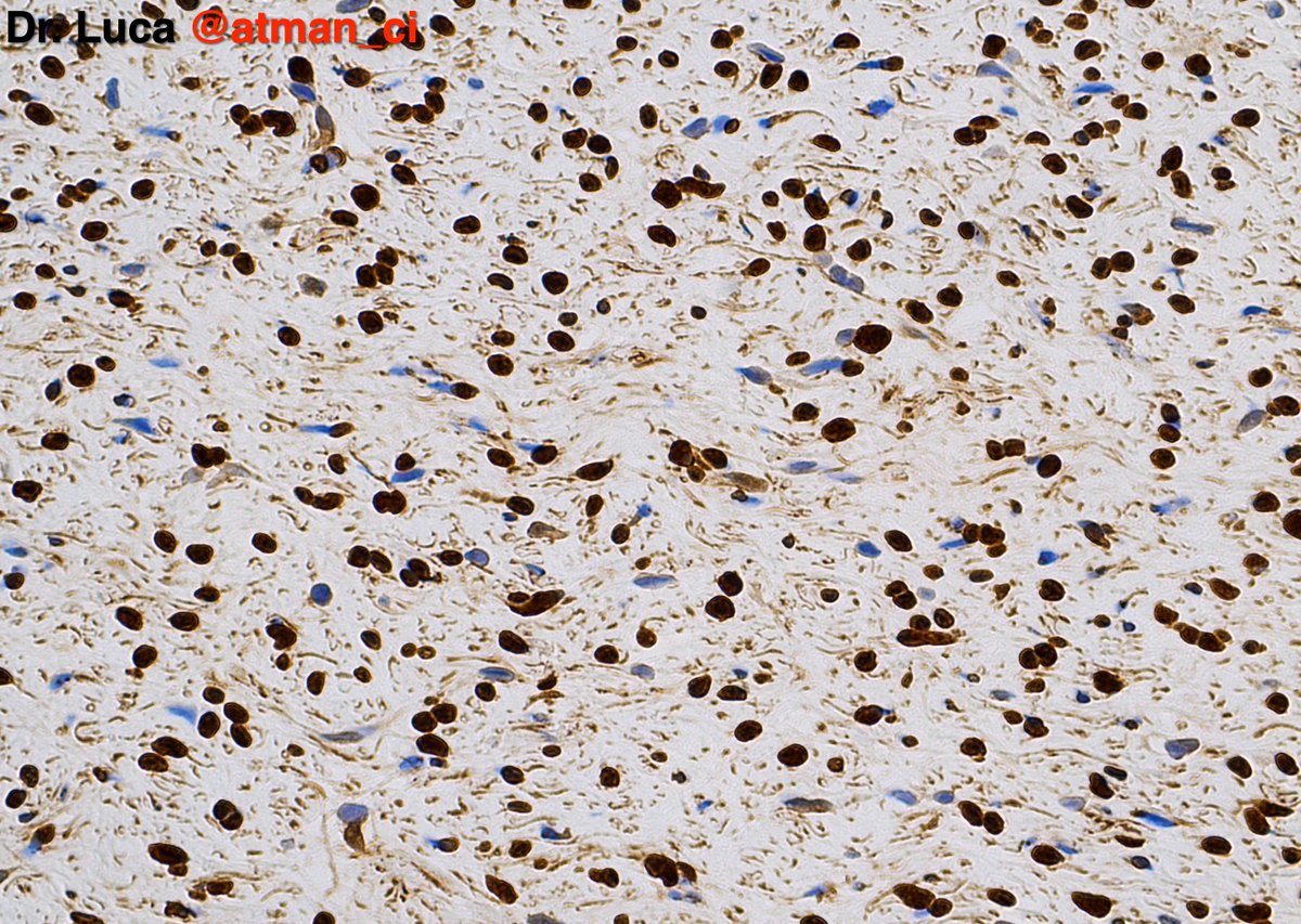 And finally Case N°3, a classic in #BSTPath #DermPath with this I wish you a great WeekEnd! <a href="/PoloniaAntonio/">A. Polónia</a> <a href="/DrBMcGinn/">Barry McGinn</a> <a href="/NeoCrazee/">SANO Naoki, MD, Pathologist, Japan</a> <a href="/sumeyra_md/">Sumeyra Kartal</a> @caseypschukow <a href="/LepinePathol/">Charles Lépine, MD</a> <a href="/rehdam/">Rehdam (Madiha)</a> <a href="/ZKrikic/">zigic krikic</a> <a href="/nusrat_xahra/">🔻Nusrat Zahra🔻🇵🇸</a> <a href="/Kashifhazim/">Kashif M M, MD, FRCPath</a> <a href="/goziemnweke/">idlewild</a> <a href="/Venkateshgilly2/">Venkatesh Dhanasekaran</a> #pathology #PathTwitter