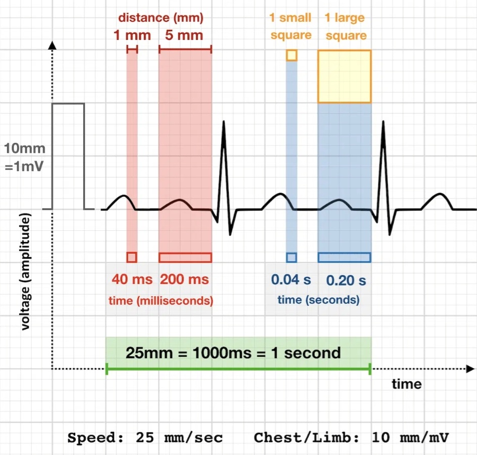 walinjom's tweet photo. ECG Basics:

-1 SMALL square (1mm) = 0.04 sec (40ms)

-5 SMALL squares (5mm) = 1 LARGE square = 0.2 sec (200ms)

-5 LARGE squares = 1 second https://t.co/993rFIPvX1