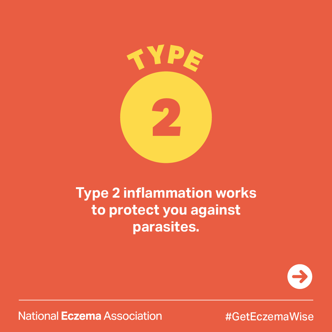 nationaleczema's tweet photo. 80% of people with #atopicdermatitis have type 2 #inflammation in their bodies.
Read more about inflammation and its role in #eczema: https://t.co/CzA9P0tD66
#GetEczemaWise #dermtwitter #inflammatoryskincondition #inflammatorycondition https://t.co/lpXoFpQL8b