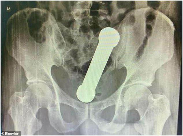 Kadeesayong's tweet image. ชายอายุ 54 ในบราซิลเข้ารักษาตัวในโรงพยาบาลหลังมีอาการปวดท้องถ่ายไม่ออกเพราะมีดัมเบลหนัก 2 กก.ยาว 20 ซม.อยู่ในทวาร จริงๆ มันติดอยู่ในนั้นมาสองวันแล้วเจ้าตัวพยายามเอาออกเองแต่ไม่สำเร็จ หมอต้องใช้มือล้วงเข้าไปเกือบสุดแขนเพื่อดึงมันออกมา