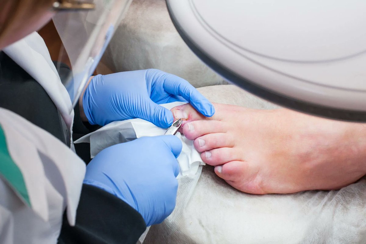 Some individuals may suffer from #ingrowntoenails and recieve relief from home remidies, however, it may not be effective for more severe cases. Discover the varous methods of ingrown toenail removal: buff.ly/3XhanB2 #bjcbr #podiatry #foothealth