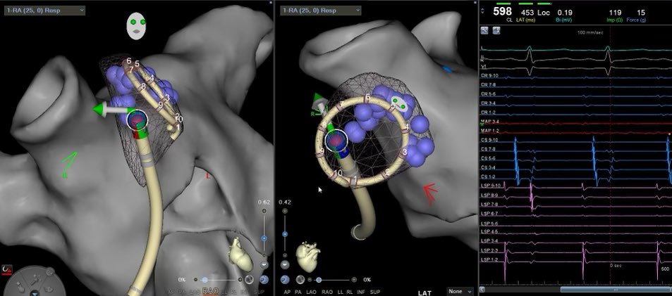 My favorite technique in isolating the SVC.  Works the majority of the time without getting too close to the phrenic nerve. #EPeeps