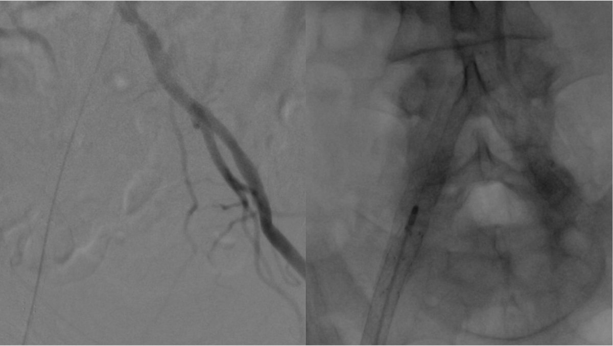 Watts_IR's tweet photo. Always hate chronic iliac stent occlusions. I even Rotarex to remove potential emboli. Here I still sent embolus to P3. @Surmodics #Pounce saved the day and the leg. Fibrous rubberized embolus removed in one pass.  This thing was not going to succumb to thrombolytics! #irad https://t.co/ttJqW7R3oS
