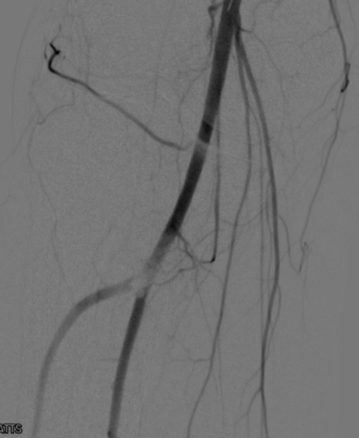Watts_IR's tweet photo. Always hate chronic iliac stent occlusions. I even Rotarex to remove potential emboli. Here I still sent embolus to P3. @Surmodics #Pounce saved the day and the leg. Fibrous rubberized embolus removed in one pass.  This thing was not going to succumb to thrombolytics! #irad https://t.co/ttJqW7R3oS