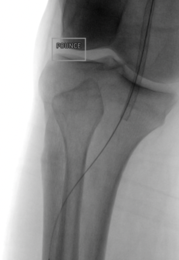 Watts_IR's tweet photo. Always hate chronic iliac stent occlusions. I even Rotarex to remove potential emboli. Here I still sent embolus to P3. @Surmodics #Pounce saved the day and the leg. Fibrous rubberized embolus removed in one pass.  This thing was not going to succumb to thrombolytics! #irad https://t.co/ttJqW7R3oS