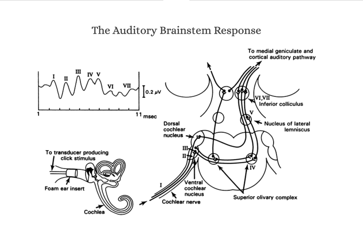 SBase360's tweet photo. Here is an example of an intra-operative evoked auditory brainstem response (eABR) obtained during recent ABI placement... notice the first wave identified is wave III, because the ABI bypasses the cochlea and cochlear nerve (see diagram). #houseinstitute #NF2 https://t.co/9HiFbl390O