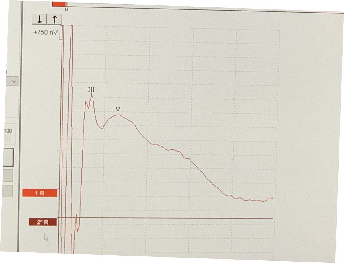 SBase360's tweet photo. Here is an example of an intra-operative evoked auditory brainstem response (eABR) obtained during recent ABI placement... notice the first wave identified is wave III, because the ABI bypasses the cochlea and cochlear nerve (see diagram). #houseinstitute #NF2 https://t.co/9HiFbl390O