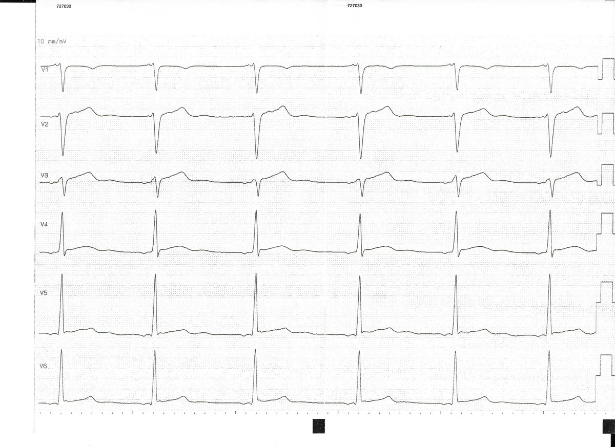 Look at that ECG. 18 j old competitive athlete. Were does this rhythm come from? #EPeeps #CardioTwitter <a href="/YoungDgk/">Young DGK</a>