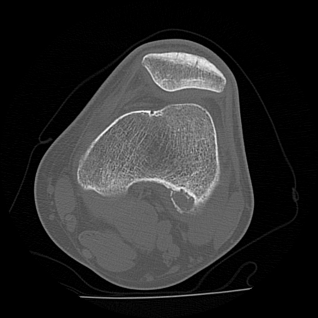 BIDMC Musculoskeletal Imaging & Intervention (@bidmc_mskimg) on Twitter photo It's time for <a href="/BIDMC_MSKImg/">BIDMC Musculoskeletal Imaging & Intervention</a>'s interesting case of the week!
⬇️ ⬇️ ⬇️
Case # 121:
Posterior knee pain in 20-year-old.
Diagnosis?
Reply by Friday, March 17! It's time for <a href="/BIDMC_MSKImg/">BIDMC Musculoskeletal Imaging & Intervention</a>'s interesting case of the week!
⬇️ ⬇️ ⬇️
Case # 121:
Posterior knee pain in 20-year-old.
Diagnosis?
Reply by Friday, March 17!