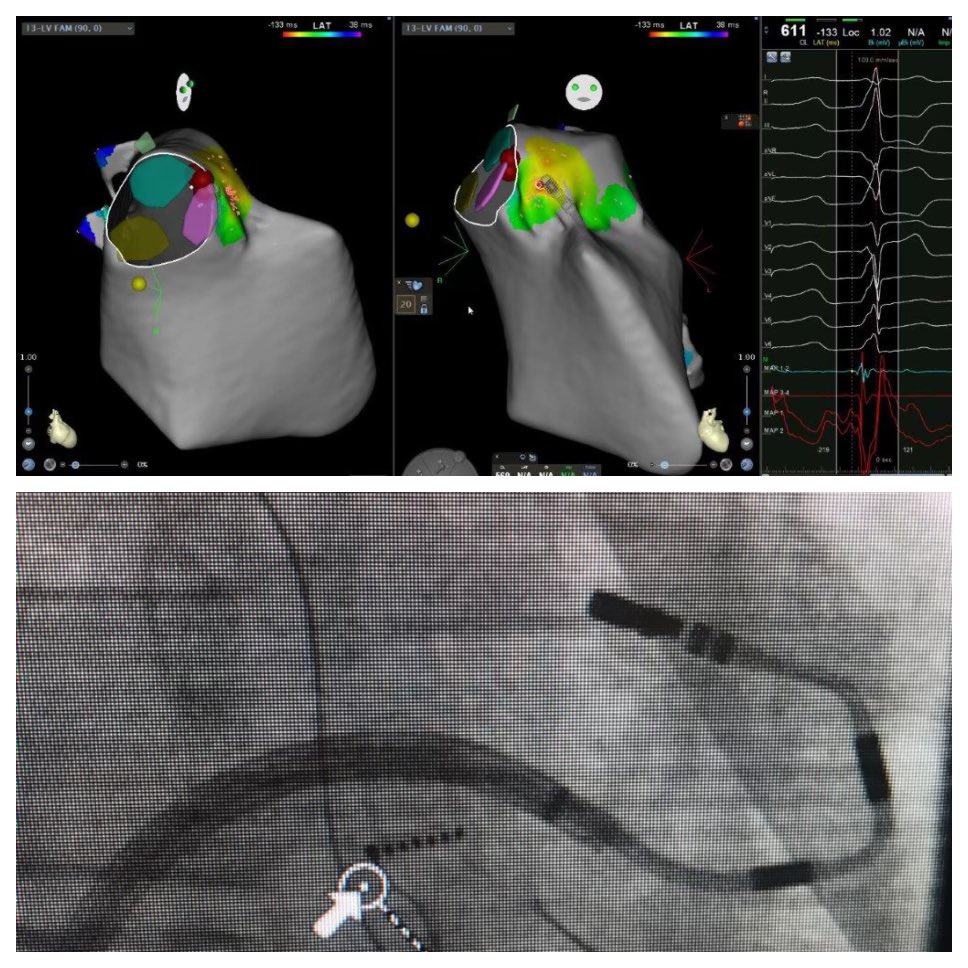 For awhile i thought u could only ablate lvot pvcs retrograde, but transeptal with RMT catheter works great for this. @Stereotaxis @BiosenseWebster