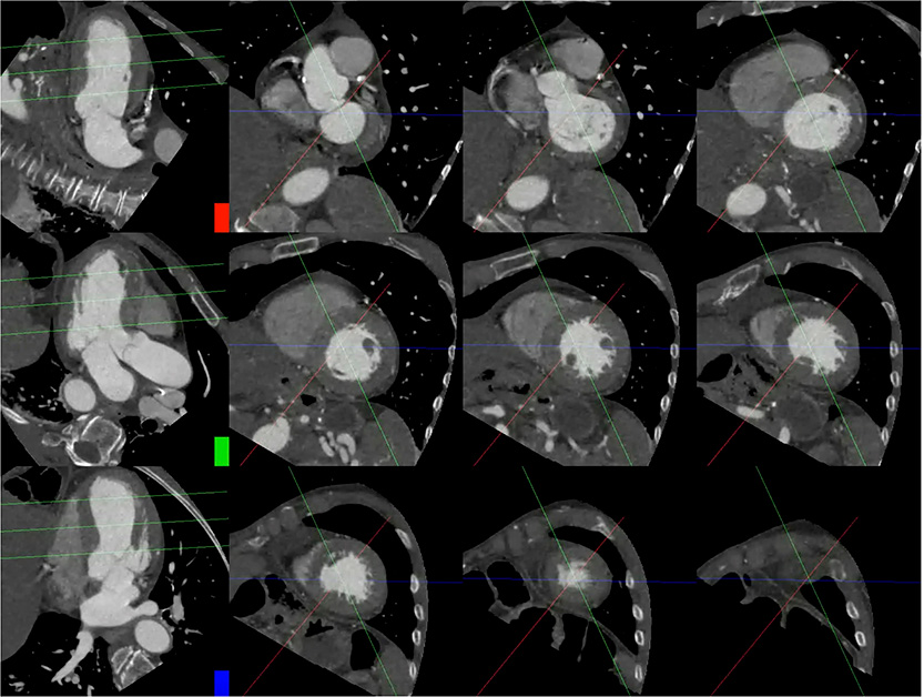 RadiologyCTI's tweet photo. NEW PUBLICATION
📜 Myocardial Regional Shortening to Detect LV Wall Motion Abnormality 
🔹Regional endocardial shortening on #YesCCT  interchangeable w/ expert visual analysis for abn seg wall motion, may be used as objective decision classifier
⛓️https://t.co/wtujohPFQi https://t.co/4dzPEZlRKs
