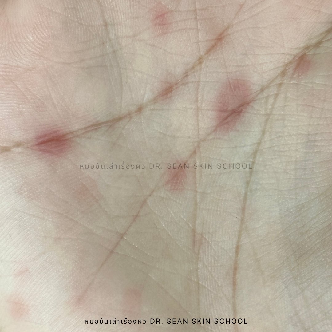 เดือนที่แล้วผมเจอซิฟิลิสหลายเคส คนไข้มาด้วยผื่นที่ตัว แขนขา ตรวจเจอผื่นที่ฝ่ามือด้วย ส่งตรวจแล็บยืนยันการวินิจฉัยได้ว่าเป็นซิฟิลิสระยะที่ 2 (Secondary syphilis) ครับ #หมอซันเล่าเรื่องผิว /1
