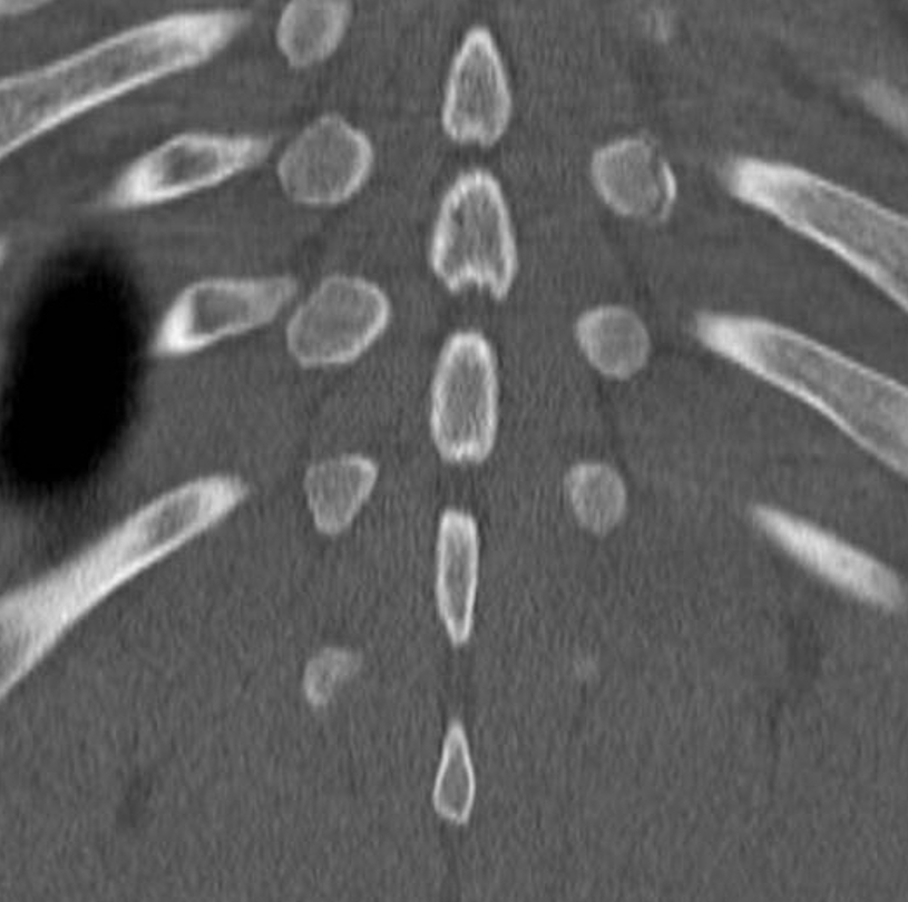 mskteachingroom's tweet image. Similar case to yesterday&apos;s 🤩this time apophyseal injury at the level of the transverse process

#spineimaging 
#medtwitter
#radres
#FOAMrad 
#radiology