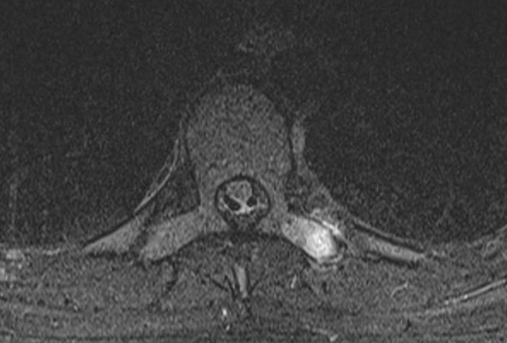 mskteachingroom's tweet image. Similar case to yesterday&apos;s 🤩this time apophyseal injury at the level of the transverse process

#spineimaging 
#medtwitter
#radres
#FOAMrad 
#radiology