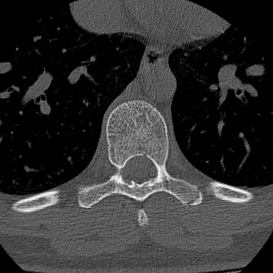mskteachingroom's tweet image. Similar case to yesterday&apos;s 🤩this time apophyseal injury at the level of the transverse process

#spineimaging 
#medtwitter
#radres
#FOAMrad 
#radiology
