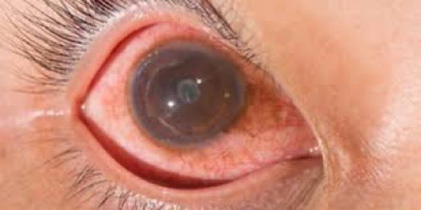 BrownJHM's tweet photo. A 32-year-old female awoke with profound blurriness in the right eye. She has also constant joint aches, frequent headaches, neck pain. She also noted recurrent oral ulcers &amp; a recent genital ulcer. What is the likely diagnosis? #Medtwitter (Image: derm advisor) https://t.co/RmY6y8Jc0d