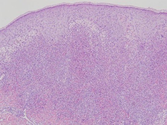 BrownJHM's tweet photo. A 32-year-old female awoke with profound blurriness in the right eye. She has also constant joint aches, frequent headaches, neck pain. She also noted recurrent oral ulcers &amp; a recent genital ulcer. What is the likely diagnosis? #Medtwitter (Image: derm advisor) https://t.co/RmY6y8Jc0d