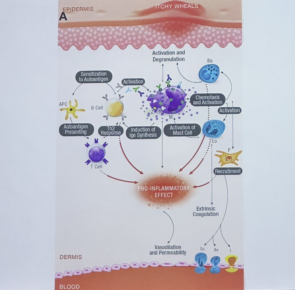 La Dra. Ferrer nos cuenta la Fisiopatologia en urticaria crónica. #iberico23 👇🏻👇🏻#CAJMIR_SEAIC
