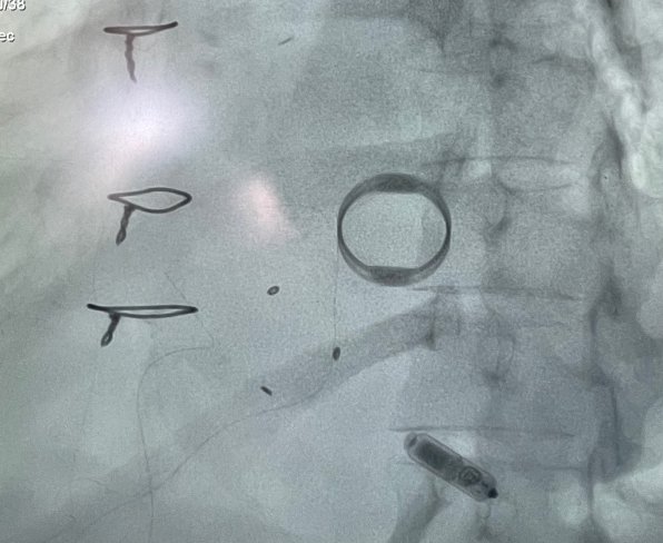 💡🫀ICOT Clinical case of the week🫀🧠

💡Un raro caso di estrazione di elettrocateteri 💡
🧠 Università degli Studi di Brescia. 

❗️Leggi il caso clinico completo 
👉📌 italiancot.it/2023/03/10/un-…
 #cardiologyfellow #cardiologia #ECG #cardiovascular #echocardiography  #ITcardiology