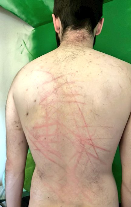 Hey, if you want to see how I got these scratches, you need to subscribe to my🌶 page!  https://t.co/VkFdJDepgj  #onlyfans<a href="/tag/onlyfans"class="tags"><span>#onlyfans</span></a><a href="/tag/onlyfan"class="tags"><span>#onlyfan</span></a><a href="/tag/onlyfansmodel"class="tags"><span>#onlyfansmodel</span></a><a href="/tag/onlyfanspr"class="tags"><span>#onlyfanspr</span></a>