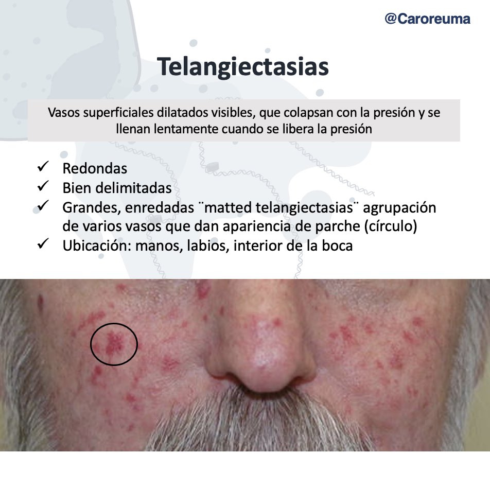 DraCaroQuintero's tweet photo. Hallazgos semiológicos en esclerosis sistémica 👇🏼🤓 https://t.co/IJVt7RvBX7