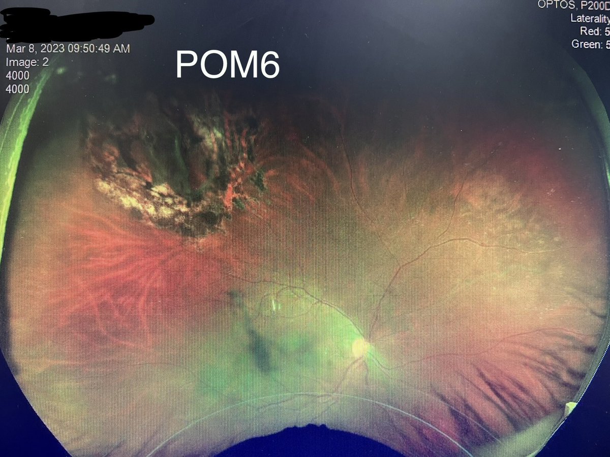 greg_budoff's tweet photo. Not much more satisfying than a successful in-office repair of retinal detachment #pneumaticretinopexy #retina https://t.co/AHrcr2ckkM