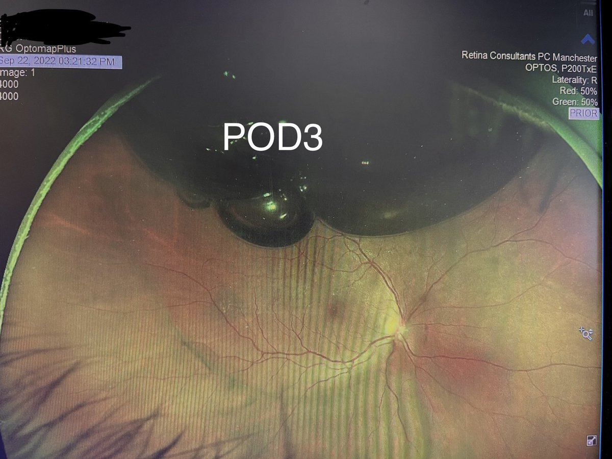 greg_budoff's tweet photo. Not much more satisfying than a successful in-office repair of retinal detachment #pneumaticretinopexy #retina https://t.co/AHrcr2ckkM
