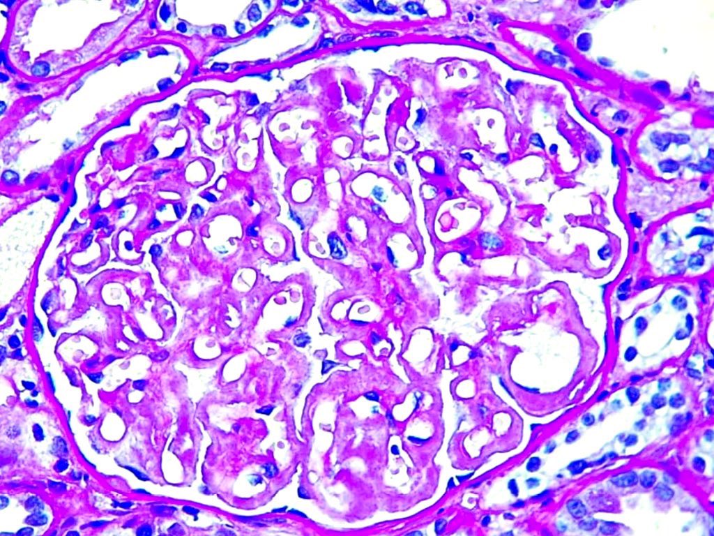 ClaudiaMCerpa's tweet photo. Mujer de 55 años. Proteinuria masiva, inmunológicos negativos. Dx. Amiloidosis glomerular con patrón membranoso. #amyloidosis #RenalPath #kidneypathology https://t.co/1nr5Oggnyl