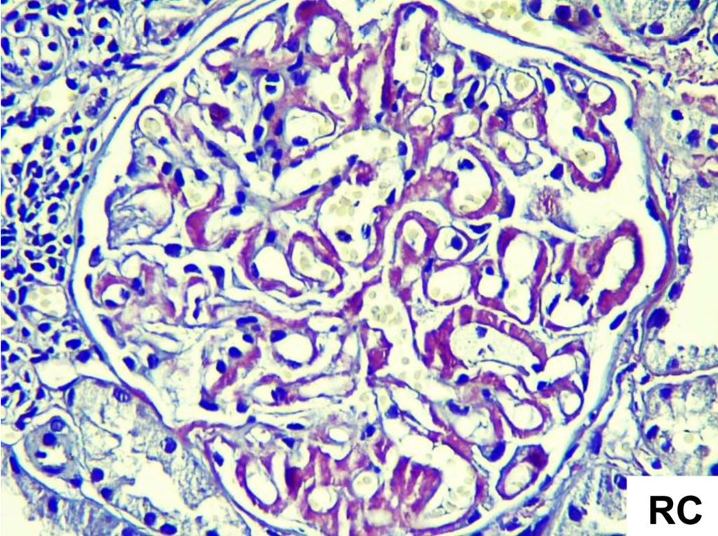 ClaudiaMCerpa's tweet photo. Mujer de 55 años. Proteinuria masiva, inmunológicos negativos. Dx. Amiloidosis glomerular con patrón membranoso. #amyloidosis #RenalPath #kidneypathology https://t.co/1nr5Oggnyl