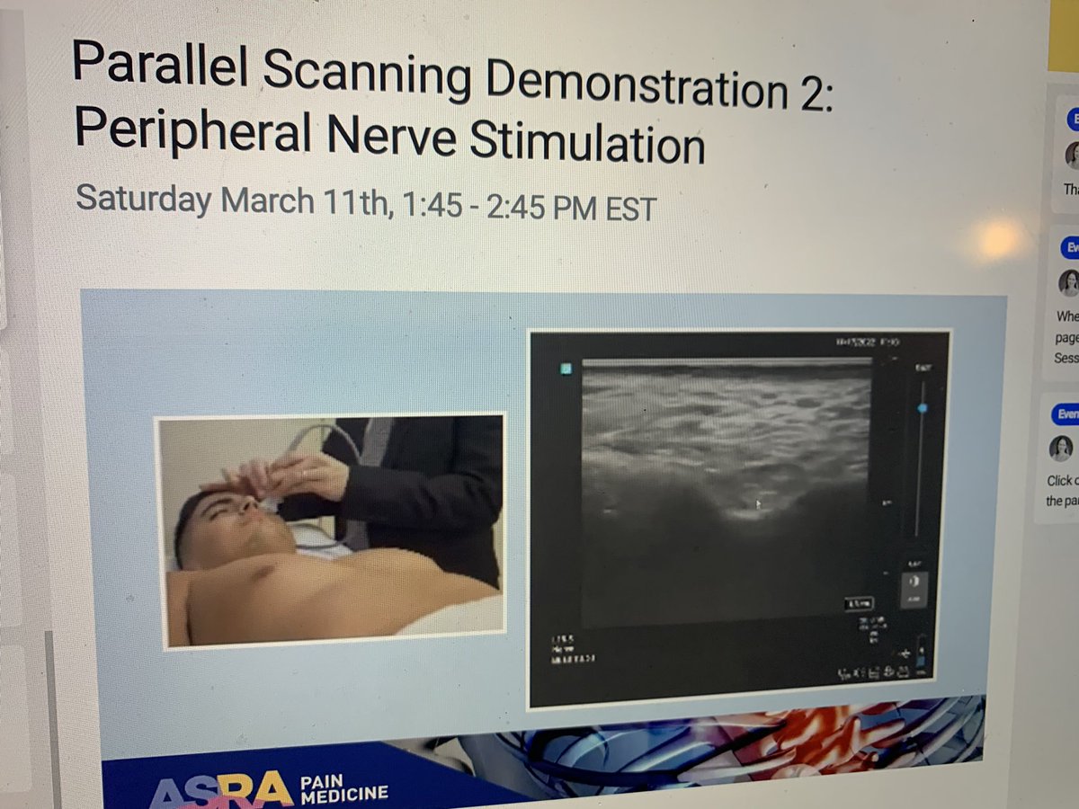 Peripheral nerve stimulation workshop live now @ASRA_Society #ASRAPPS23 @EshraghiYashar @ScottPritzlaff @NarouzeMD @DProvenzanoMD @dr_rajgupta @nelkassabany