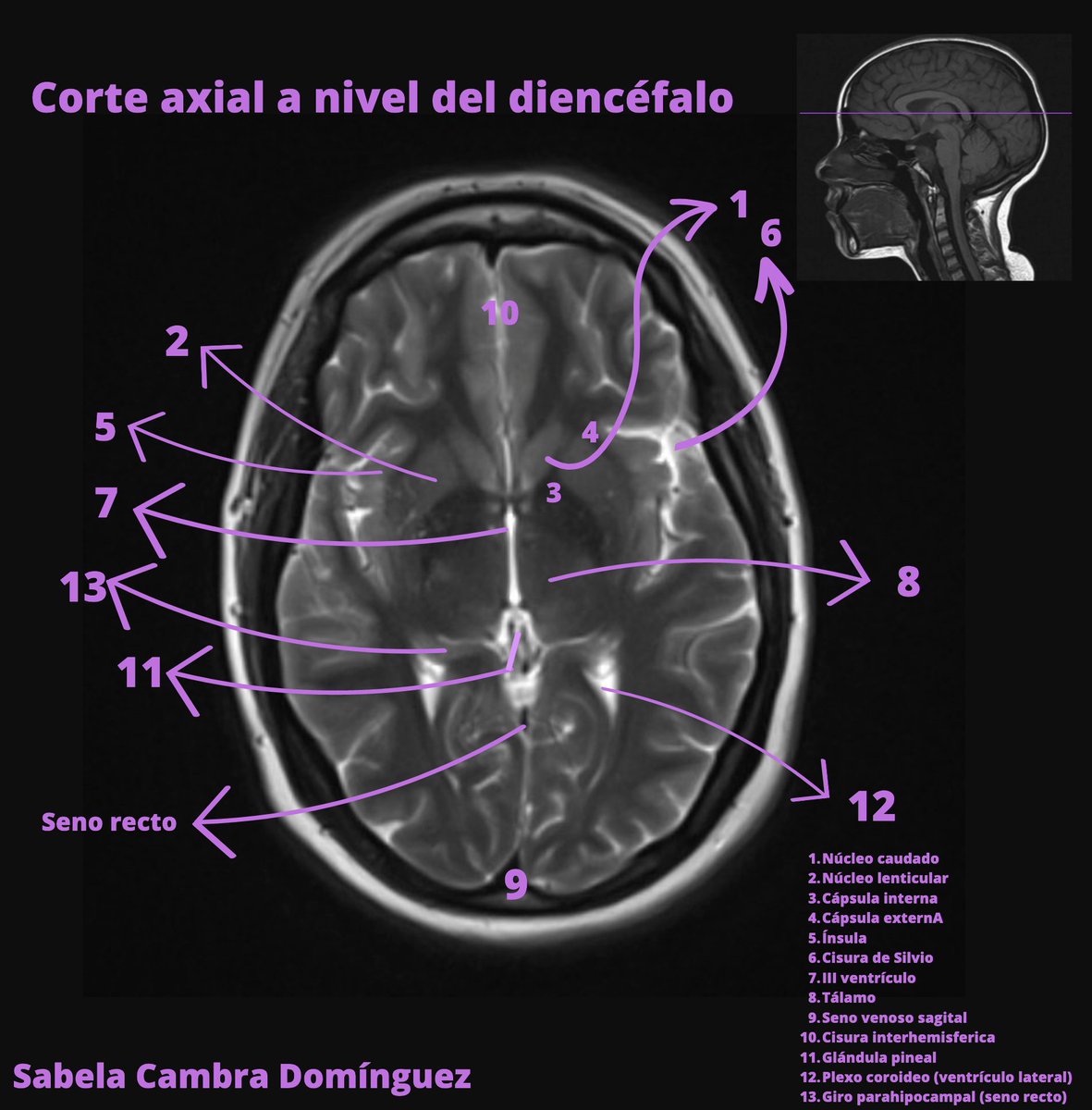 SanitariaR's tweet photo. Este trimestre hemos trabajado en clase imágenes de #resonancia 🧠
Hechas por alumn@s para alumn@s 🤩🤩🤩
#TSIDMN #anatomiaradioloxica_2023 https://t.co/aOEqEsOQ08