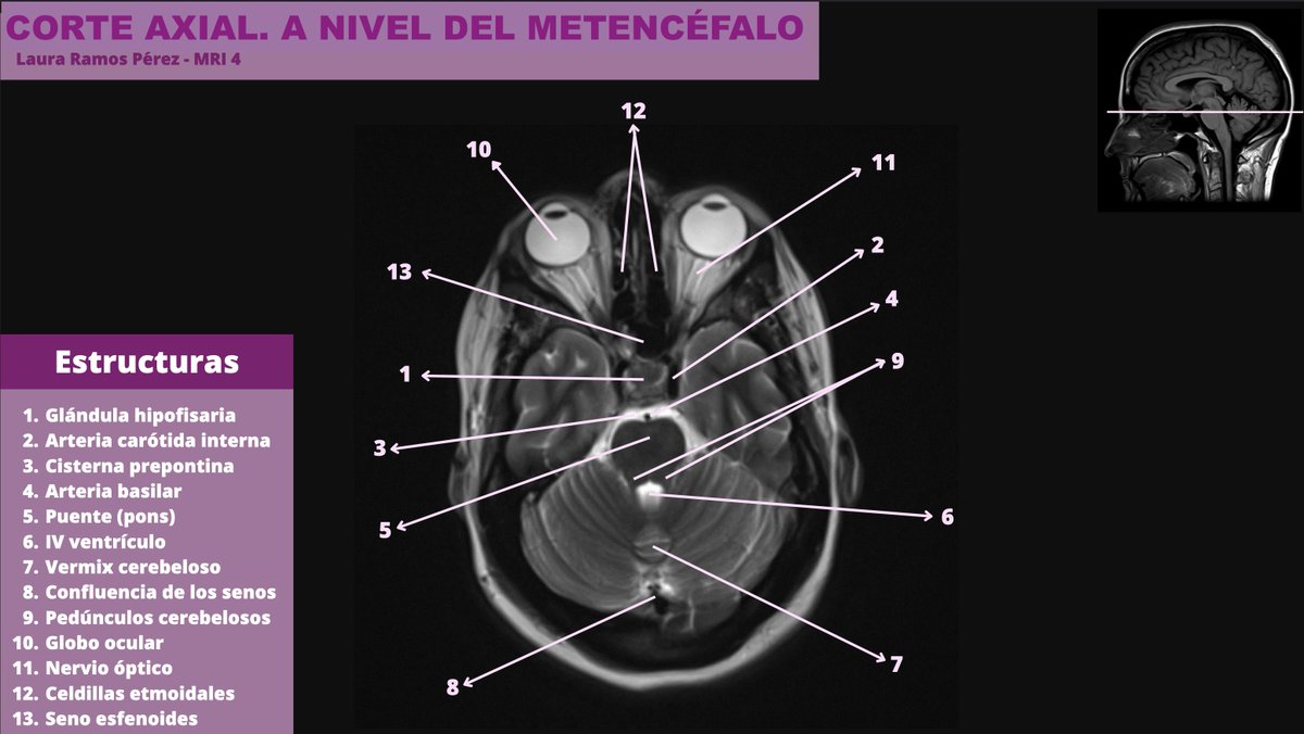 SanitariaR's tweet photo. Este trimestre hemos trabajado en clase imágenes de #resonancia 🧠
Hechas por alumn@s para alumn@s 🤩🤩🤩
#TSIDMN #anatomiaradioloxica_2023 https://t.co/aOEqEsOQ08