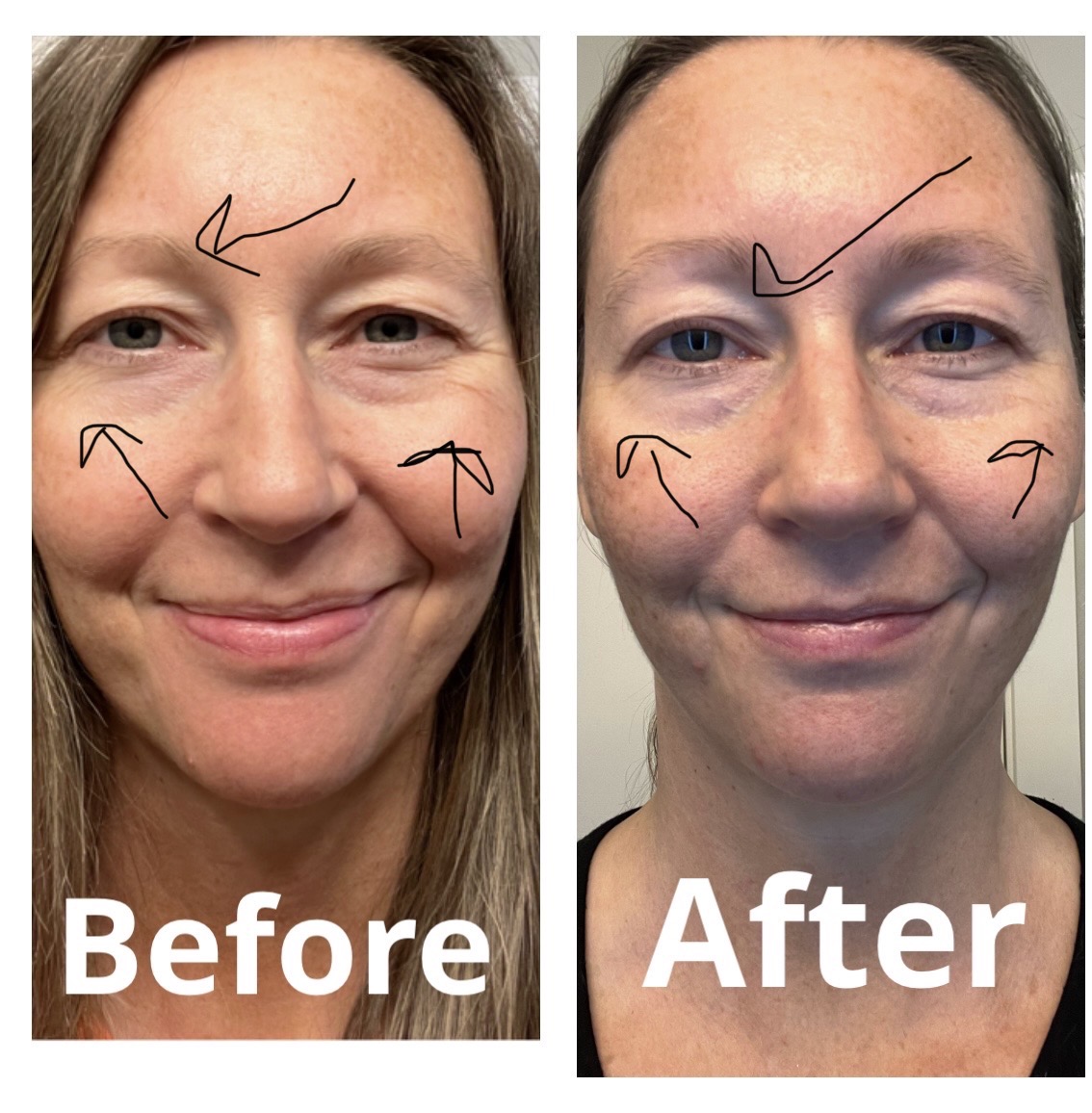 ladyboarder9669's tweet photo. RT! SHOP 15% OFF THE NIRA LASER RIGHT NOW! Look younger in 90 days! #WRINKLES CHECK OUT MY 90-day B4 & AFTER! + USE CODE: LADYBOARDER & GET EXTRA 10% OFF your order! #antiaging #skincare #antiaginglaser #lookyounger #finelines #lookyounger #glowingskin https://t.co/znRWqZv21I https://t.co/TyshhqKYyz