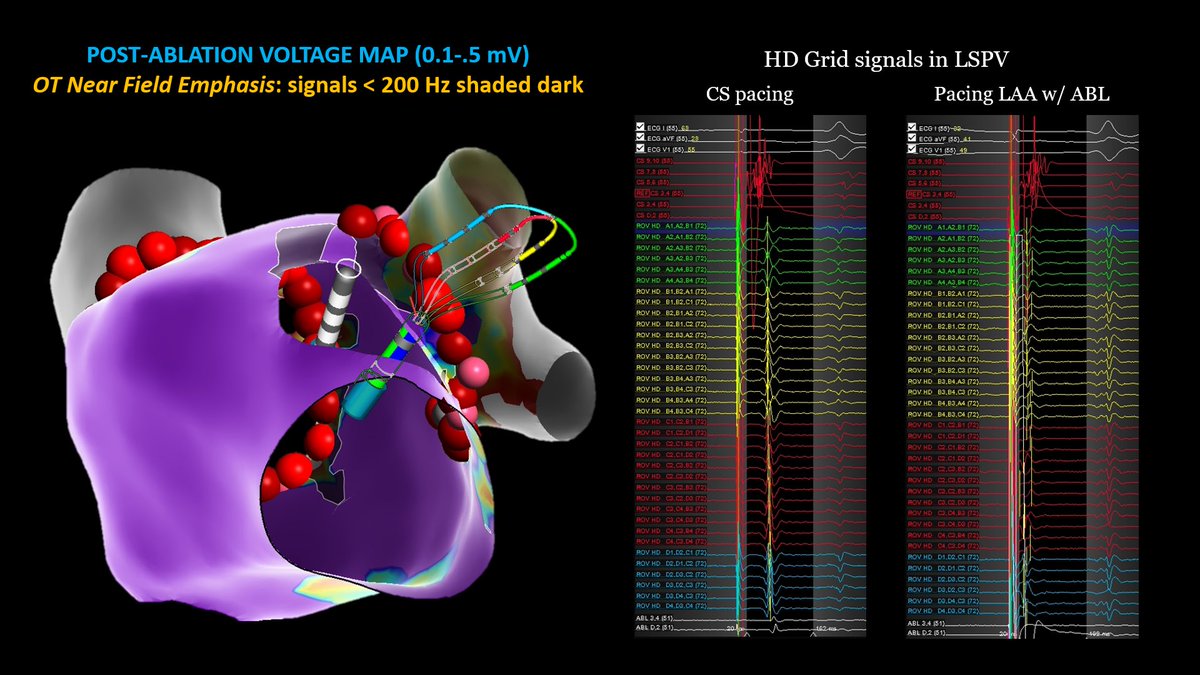 Maylyn Parsons Misiora (@subparsonsmaps) on Twitter photo Trying the new EnSite advanced mapping software, OT Near Field. Any low-frequency signal automatically shaded dark to help answer the age old question... is it far-field? OT NF "Emphasis" map confirms the classic EP maneuver, pacing from LAA. <a href="/AbbottCardio/">Abbott Cardiovascular</a> #EPeeps #OTNearField Trying the new EnSite advanced mapping software, OT Near Field. Any low-frequency signal automatically shaded dark to help answer the age old question... is it far-field? OT NF "Emphasis" map confirms the classic EP maneuver, pacing from LAA. <a href="/AbbottCardio/">Abbott Cardiovascular</a> #EPeeps #OTNearField