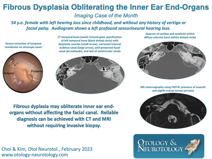 Progressive replacement of bony structures with abnormal, proliferative fibrous tissue by #FibrousDysplasia may obliterate the inner ear. bit.ly/3Rm0gbS